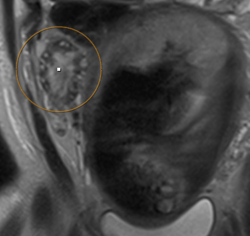 MRI showing ovarian torsion with enlarged ovary, peripheral follicles, and stromal edema on T2W