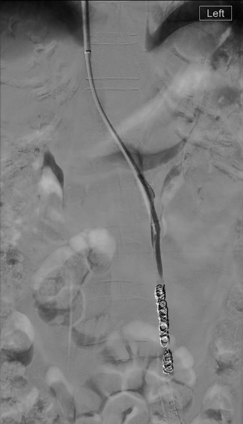 Post STS foam and coil embolization of ovarian vein showing stasis and no residual reflux