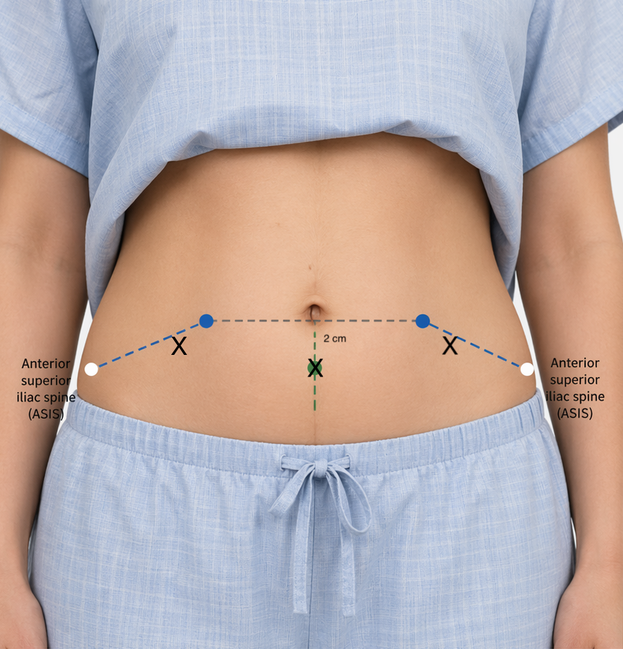 Paracentesis access site diagram showing ASIS landmarks and needle entry points lateral to the rectus sheath in the LLQ and RLQ