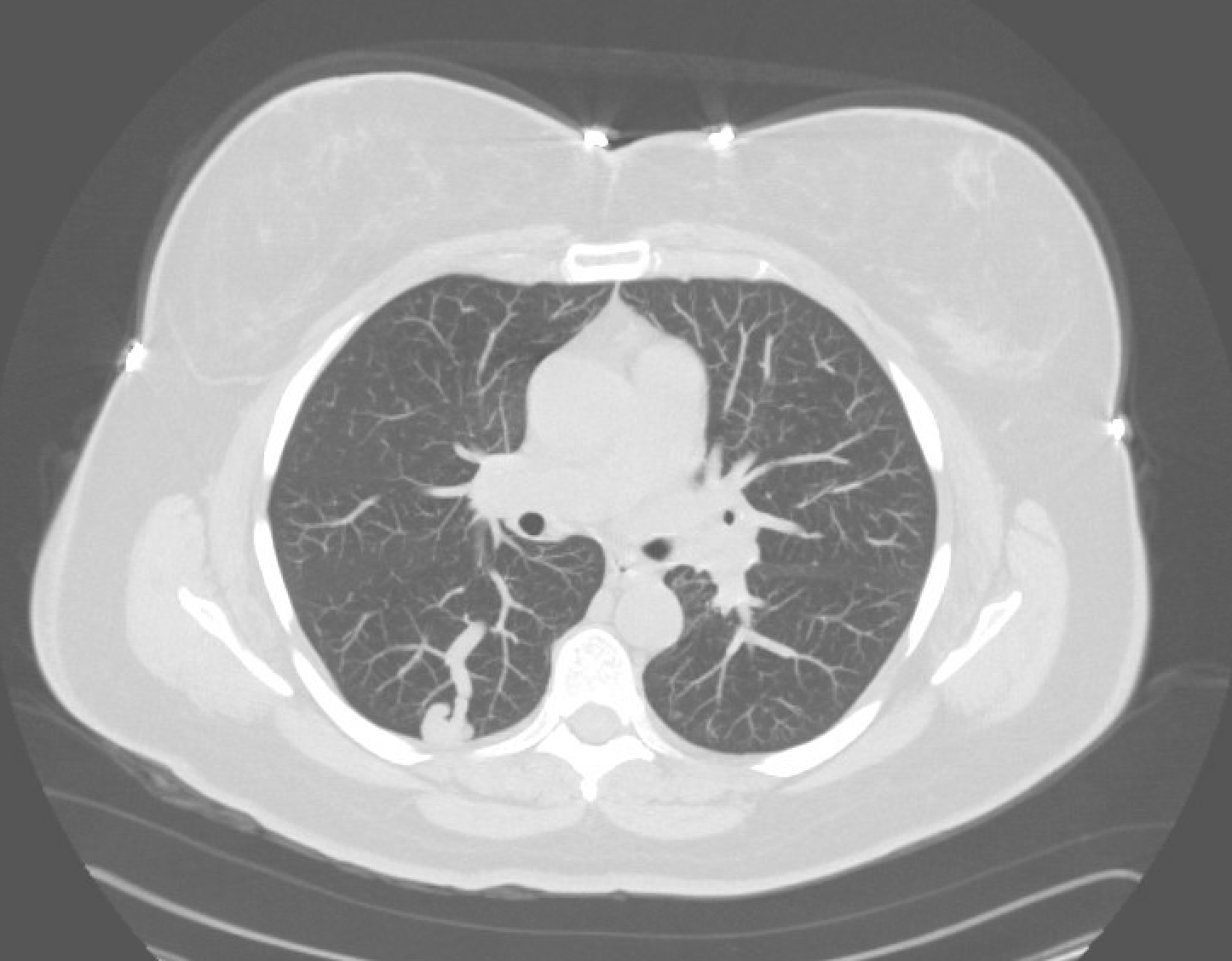CT chest showing pulmonary arteriovenous malformation with feeding artery, aneurysmal sac, and draining vein