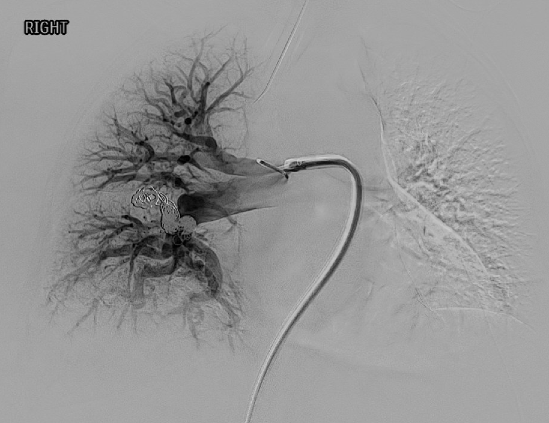 Post-embolization pulmonary angiogram showing coils in feeding artery with no residual sac filling