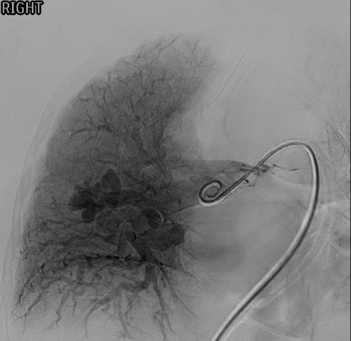 Pulmonary angiogram pre-embolization showing filling of the PAVM sac via feeding pulmonary artery