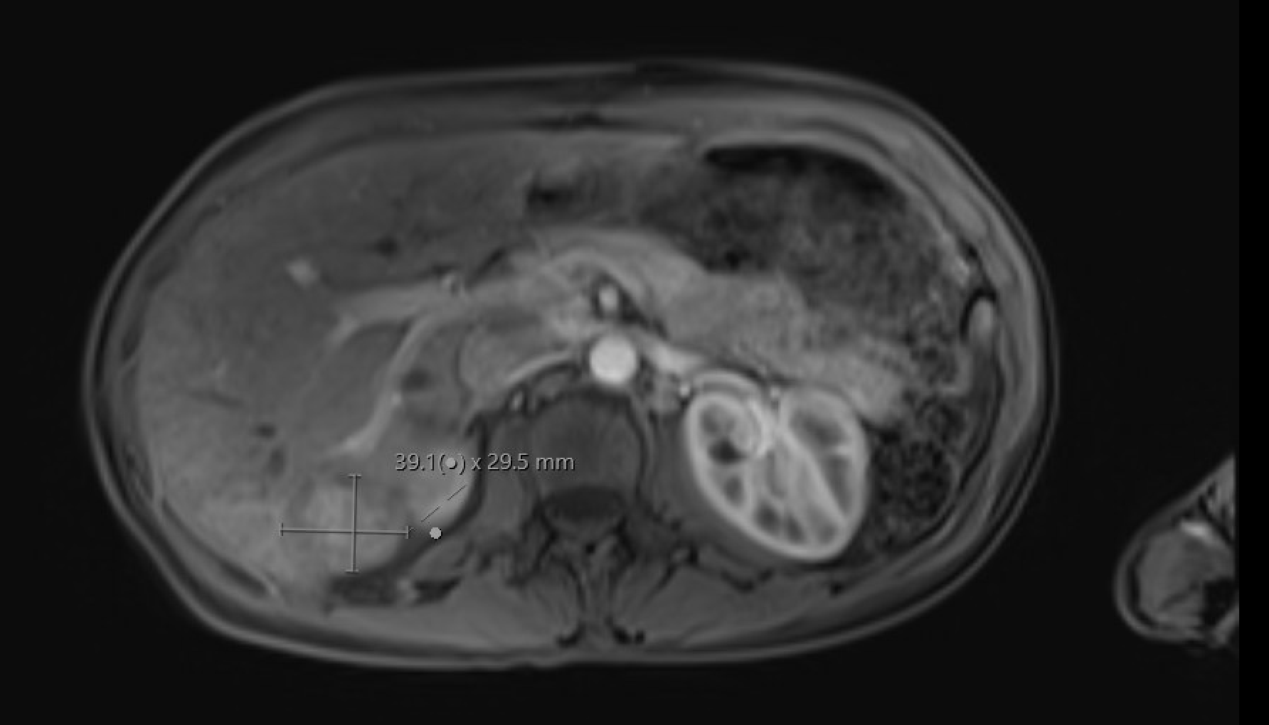 MRI showing peliosis hepatis — early post-contrast with peripheral nodular filling pattern