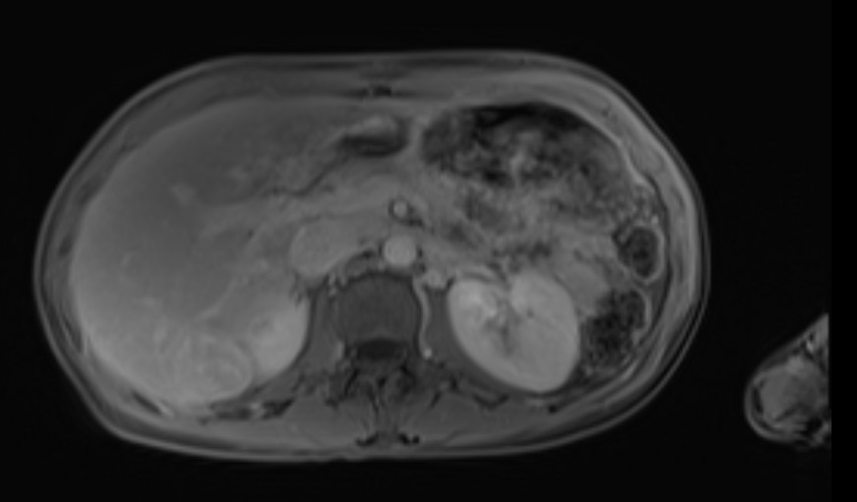 MRI showing peliosis hepatis — delayed phase becoming isointense to liver parenchyma