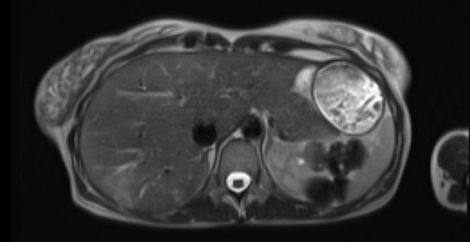 MRI showing peliosis hepatis — unenhanced phase with hypodense hepatic lesions