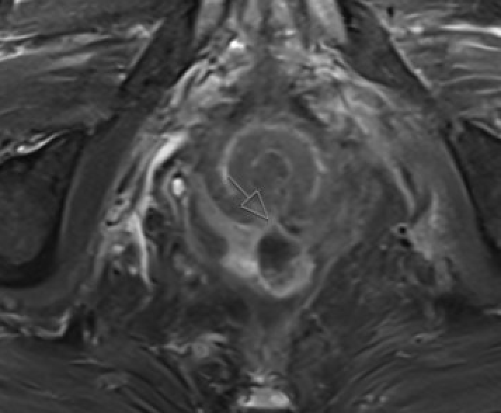 Small-FOV T2W MRI showing perianal fistula tract with internal opening at dentate line