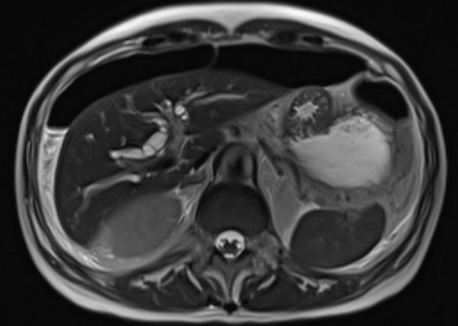 MRI showing pneumoperitoneum with T2-hypointense foci and susceptibility artifact on gradient echo sequence