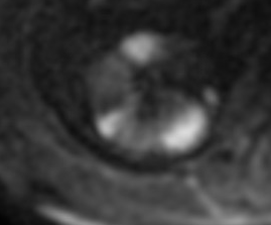 MRI showing pyelonephritis with wedge-shaped T2 hyperintensity and striated nephrogram pattern