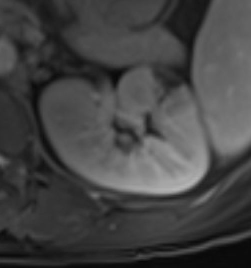 Delayed MRI showing cortical rim sign in renal infarct with preserved capsular vessel enhancement