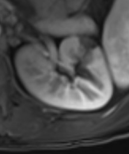 MRI showing renal infarct with wedge-shaped cortical nonenhancement
