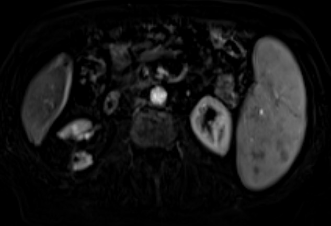 Follow-up MRI showing no enhancement after renal mass cryoablation