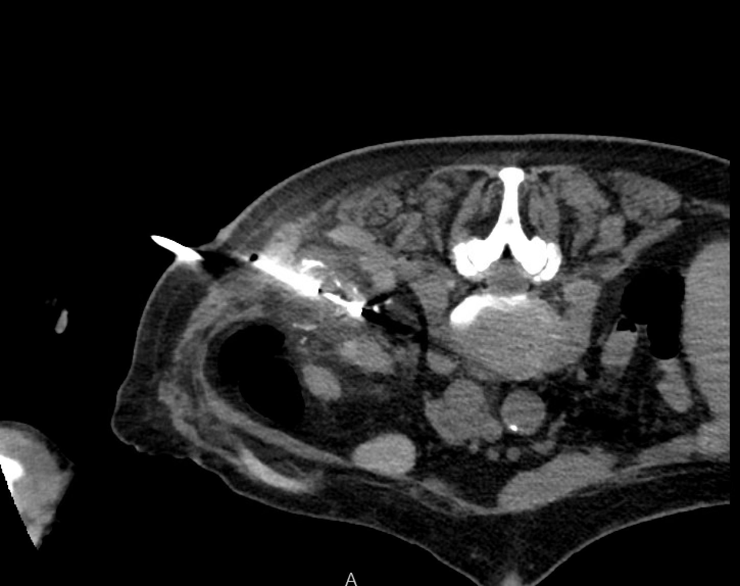 Post-cryoablation renal mass with ice ball on CT