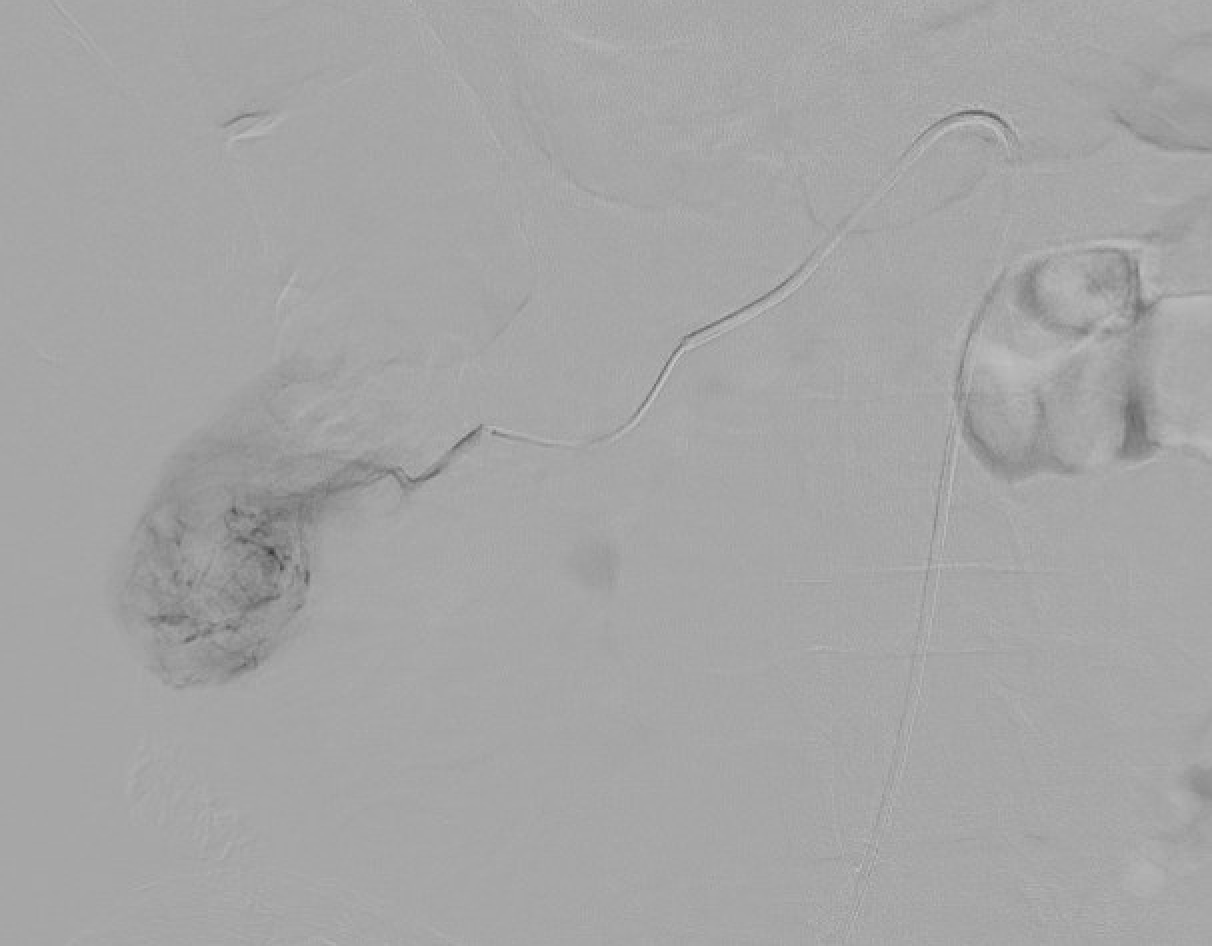 Pre-ablation angiogram showing renal mass lipiodol staining