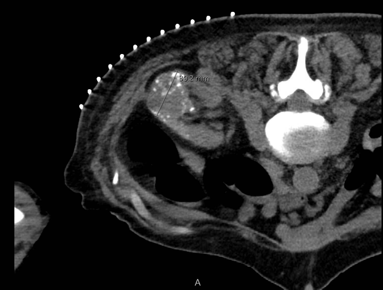 Pre-cryoablation renal mass stained with lipiodol