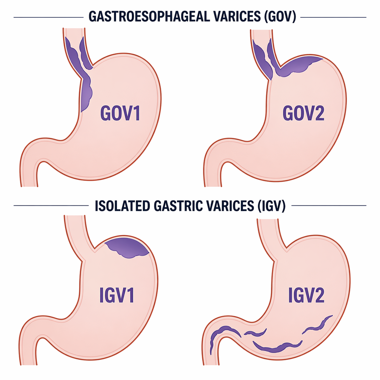 Sarin classification of gastric varices — anatomic illustrations of GOV1 (cardia along lesser curvature), GOV2 (fundus along greater curvature), IGV1 (isolated fundal), and IGV2 (elsewhere in stomach)