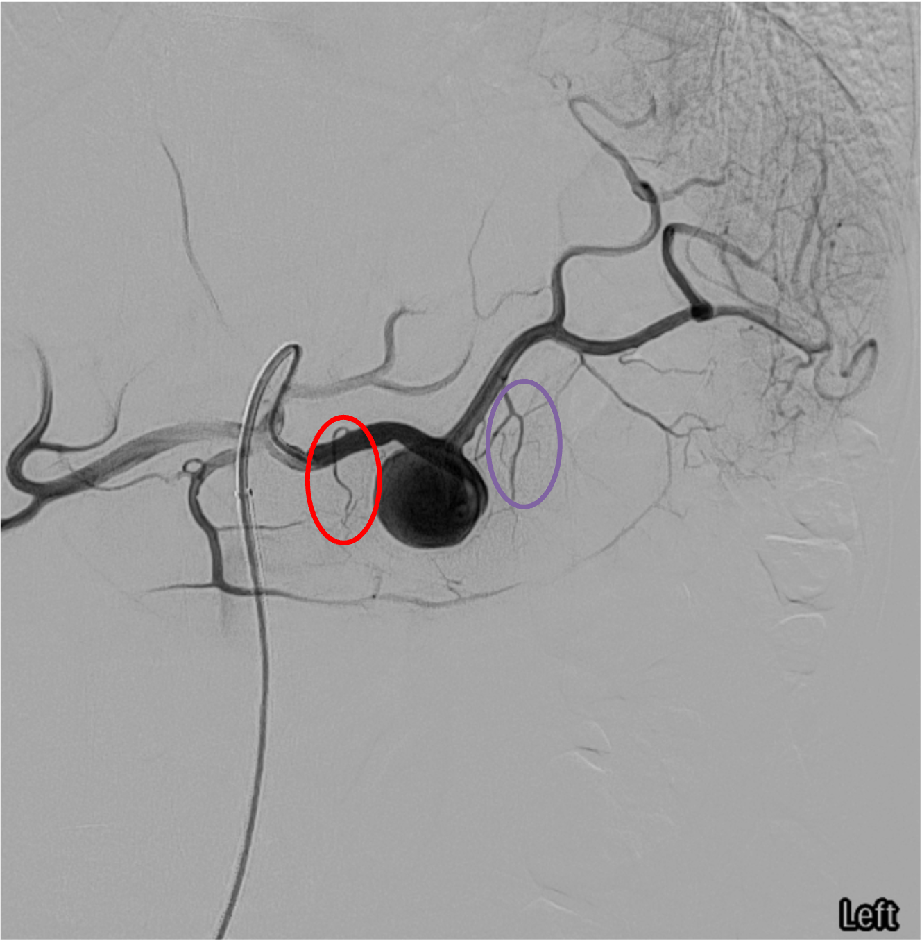 Splenic artery angiogram with dorsal pancreatic artery highlighted in red and pancreatica magna in purple