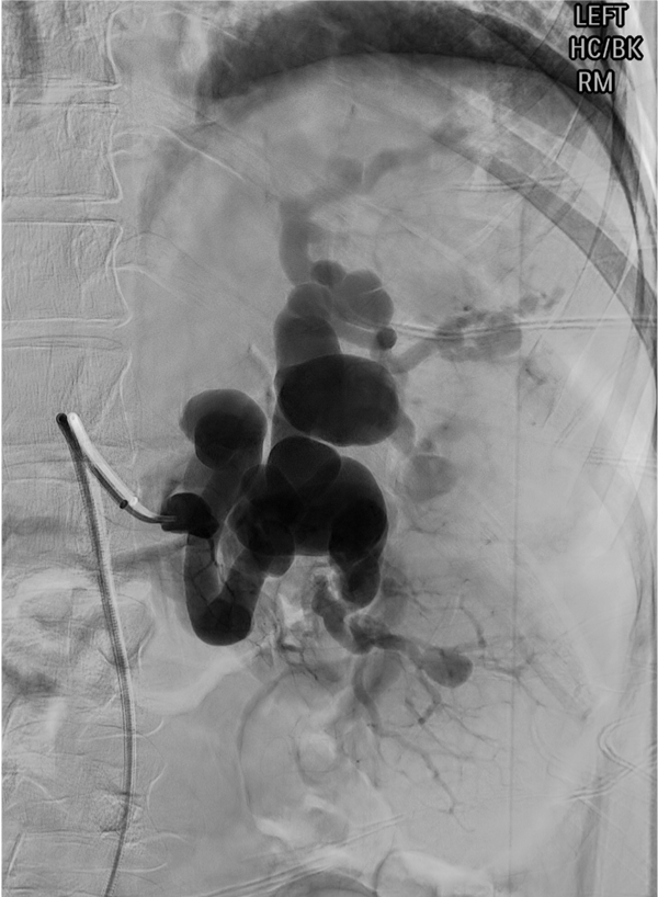 Splenic artery aneurysm on angiography showing saccular dilation of the splenic artery trunk