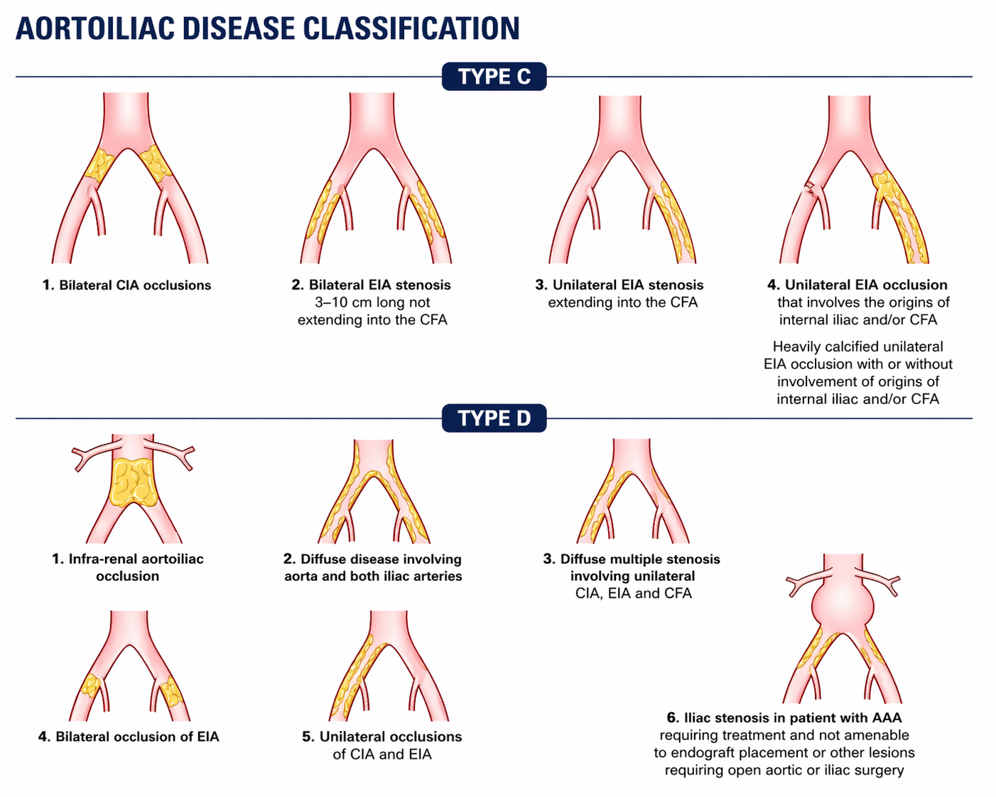 TASC II Type C and D lesion classification for SFA and popliteal artery peripheral arterial disease — complex and long segment occlusions