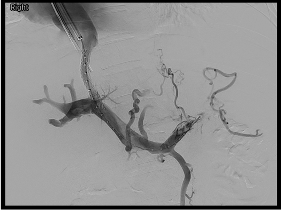 TIPS procedure diagram — transjugular intrahepatic portosystemic shunt connecting right hepatic vein to right portal vein via covered stent through hepatic parenchyma