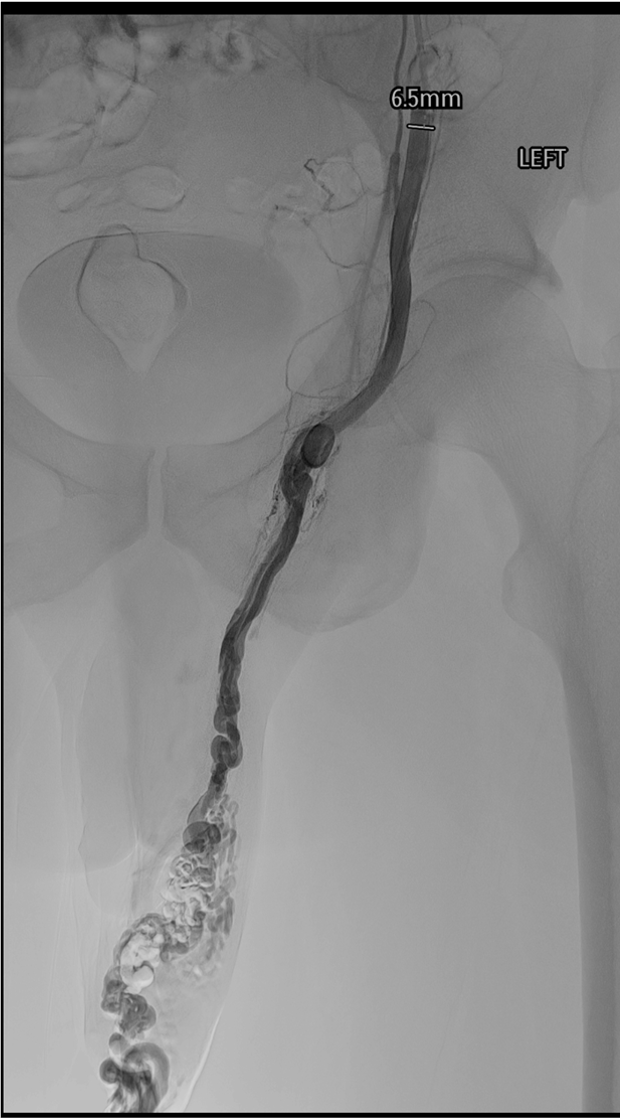 Gonadal vein venogram pre-embolization showing dilated internal spermatic vein and pampiniform plexus