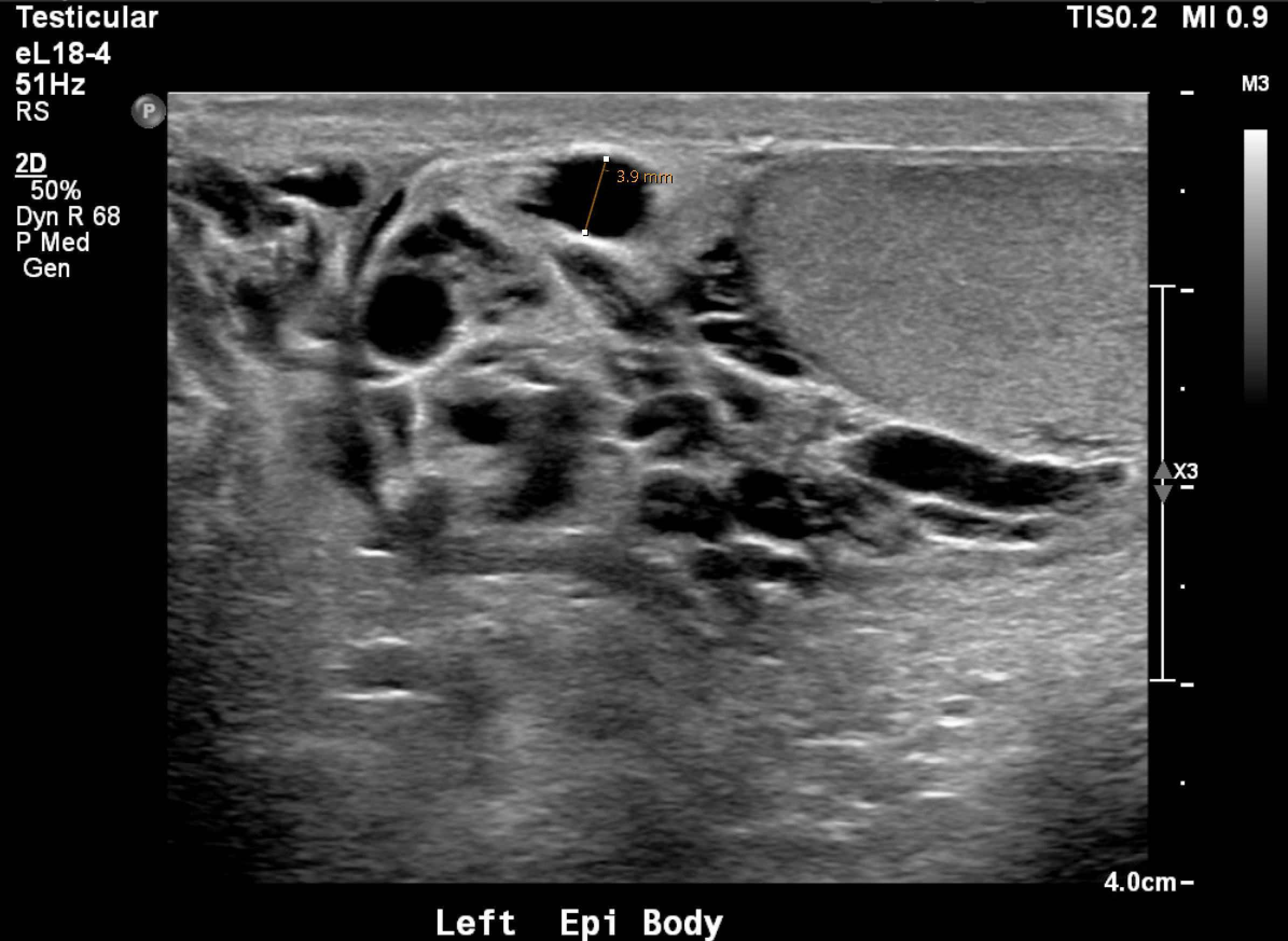 Scrotal ultrasound with color Doppler showing dilated pampiniform plexus veins consistent with varicocele