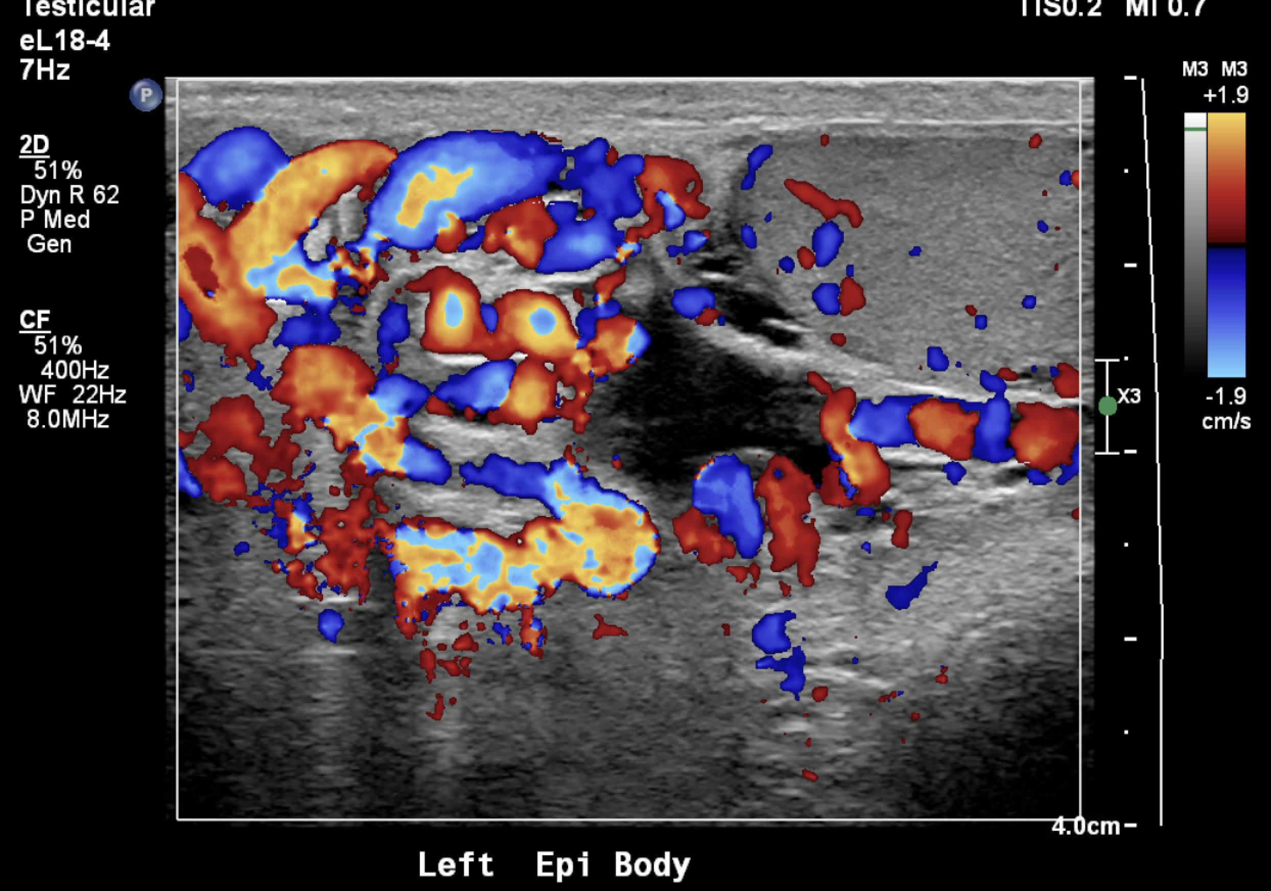 Color Doppler ultrasound showing dilated pampiniform plexus veins consistent with left varicocele