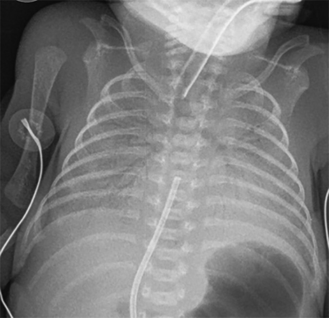 HMD (RDS) — diffuse granular pattern with air bronchograms