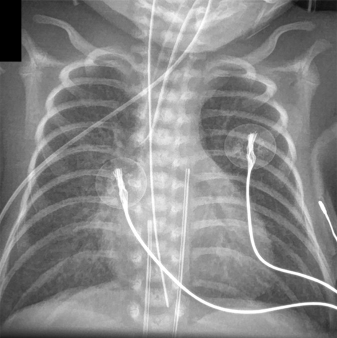 HMD (RDS) — low lung volumes and air bronchograms