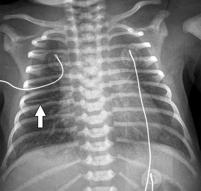 TTN — perihilar streaking and interfissural fluid