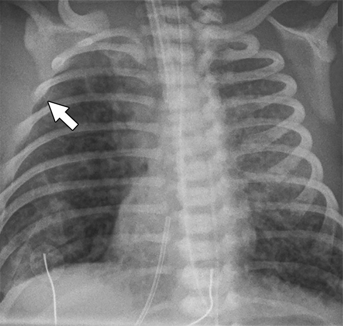Meconium aspiration syndrome — coarse asymmetric opacities with pneumothorax