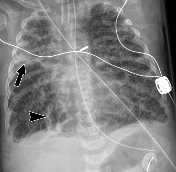 BPD — hyperinflation and cystic changes