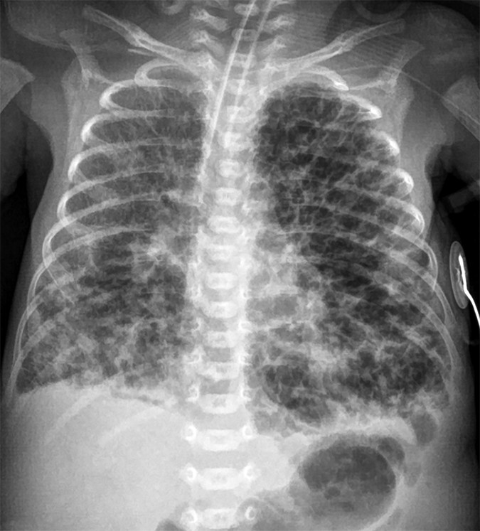 PIE — linear and cystic lucencies