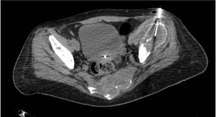 CT showing bone biopsy needle advanced through cortex into lesion