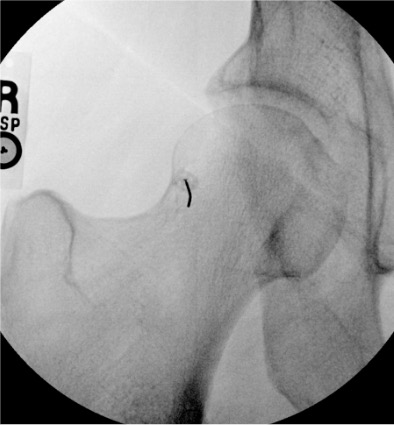 Fluoroscopic image showing needle placement at the medial femoral neck for hip arthrogram