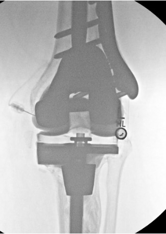 Knee arthrogram post-injection showing contrast within the knee joint