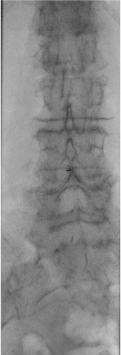 AP fluoroscopic view showing midline approach for lumbar puncture