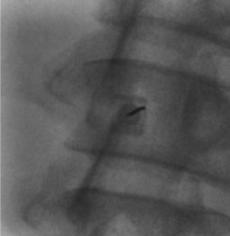 Second prone oblique view showing needle trajectory for lumbar puncture