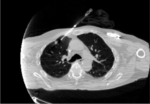 CT showing biopsy needle positioned in pulmonary lesion
