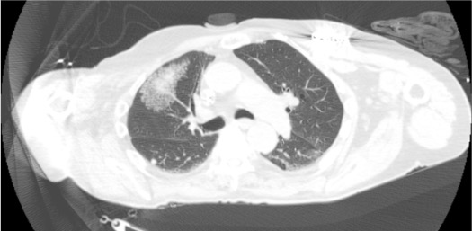 CT showing expected pulmonary hemorrhage after lung biopsy