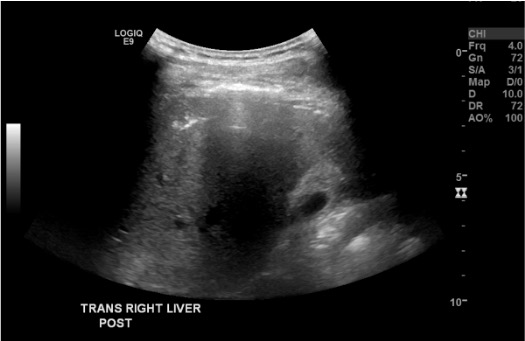 Post-biopsy ultrasound of right liver showing expected echogenic tract