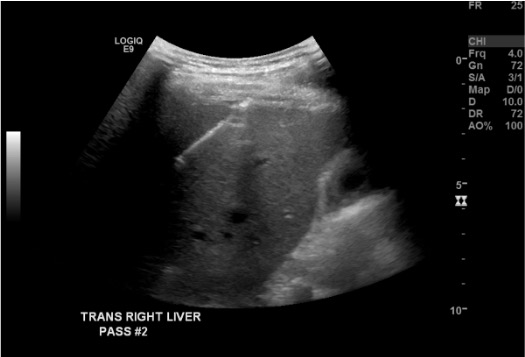 Ultrasound showing biopsy needle positioned in liver target