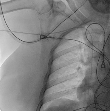 Fluoroscopy showing PICC tip at cavoatrial junction
