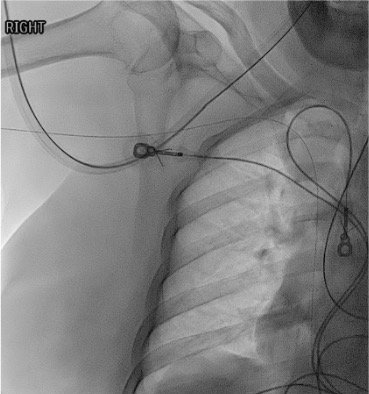 Fluoroscopy showing PICC wire looped in IVC confirming venous position