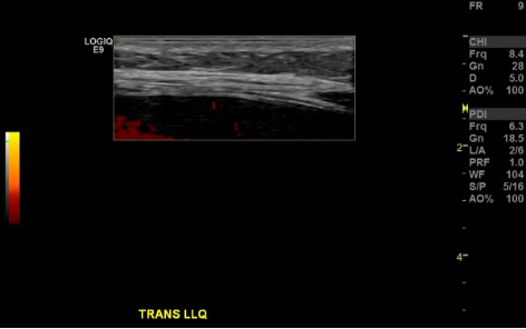Color Doppler US of LLQ showing vessel check at planned paracentesis access site