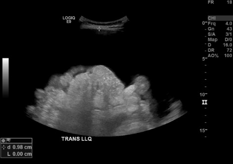 B-mode US measuring distance from skin to ascitic fluid pocket in LLQ