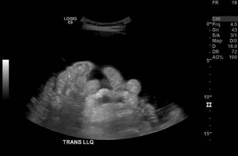 B-mode US confirming no vessels along needle trajectory in LLQ
