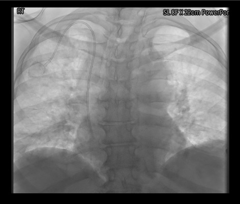 Fluoroscopy showing implanted power port with catheter tip at SVC-RA junction