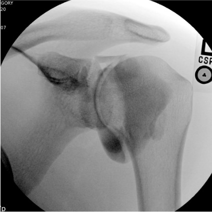 Shoulder arthrogram post-injection showing intra-articular contrast distribution in the glenohumeral joint