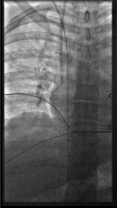 Fluoroscopy showing 0.018 wire looping in IVC confirming venous access