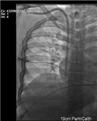 Fluoroscopy showing tunneled dialysis catheter with tip in right atrium